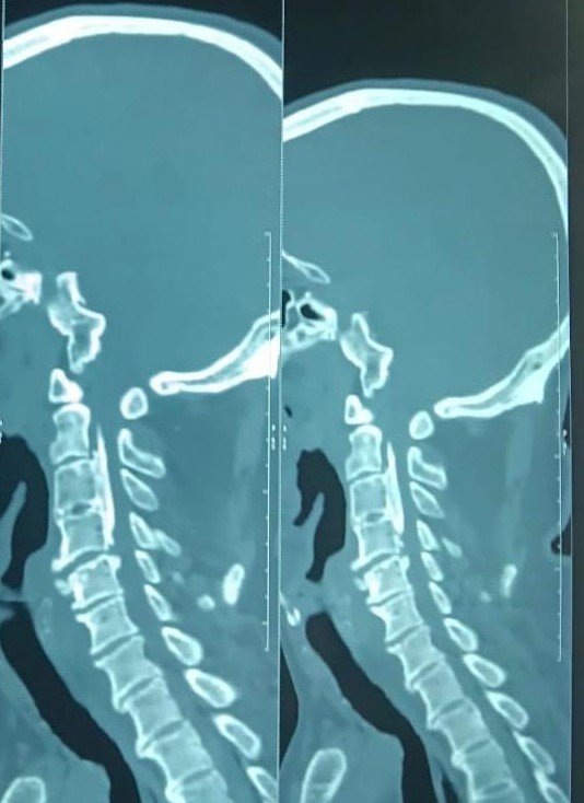 Cervical OPLL (Ossified Posterior Longitudinal Ligament) - narrowing the spinal canal.