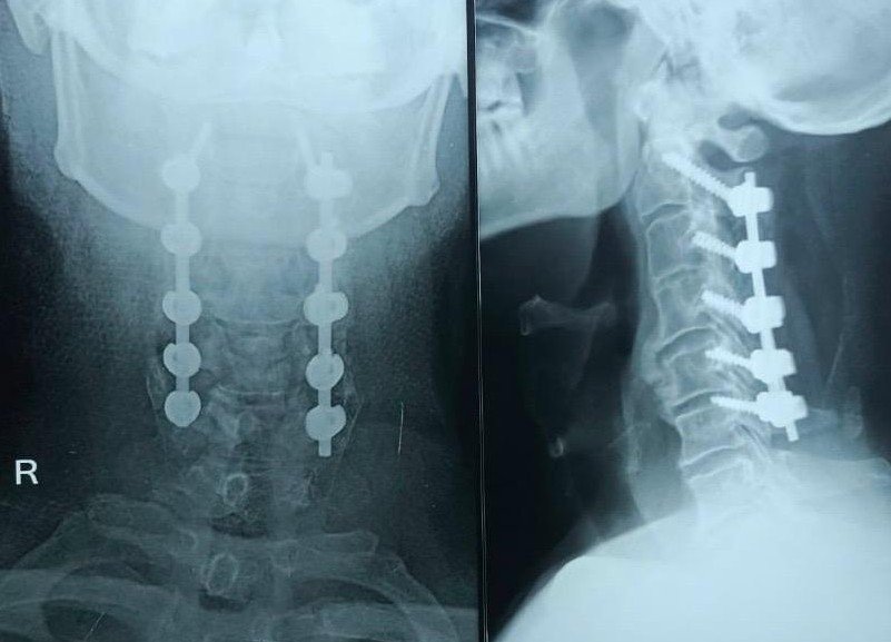 Post-operative X-ray. 