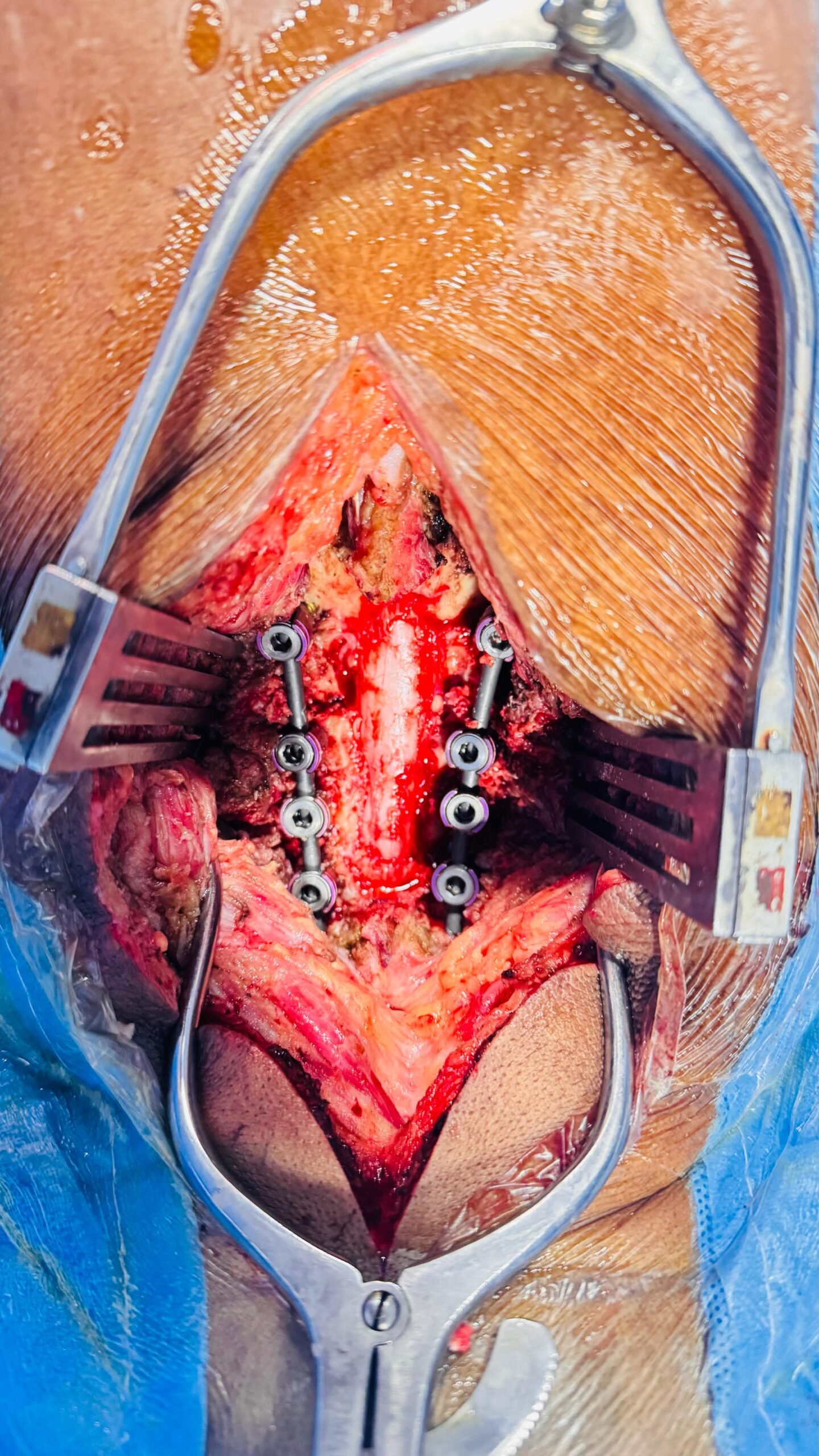 Completely decompressed spinal cord after surgery